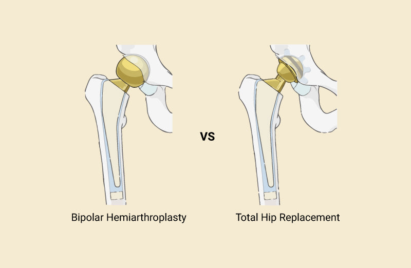 Bipolar Hemiarthroplasty Vs Total Hip Replacement Understanding The