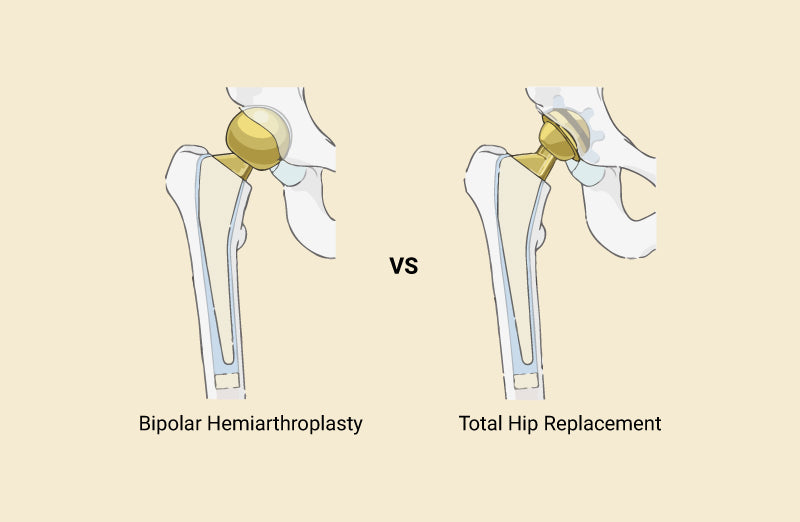 Bipolar Hemiarthroplasty vs Total Hip Replacement Understanding the