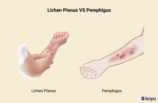 Lichen Planus Vs Pemphigus