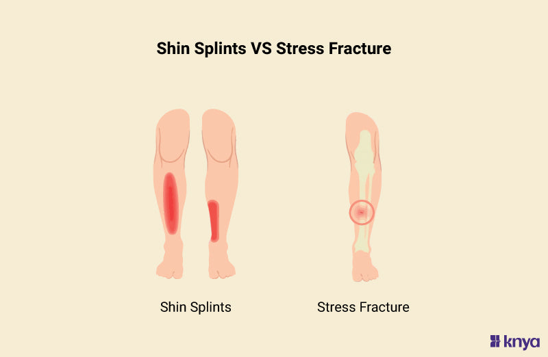 Shin Splints vs Stress Fracture, Injuries that target the lower