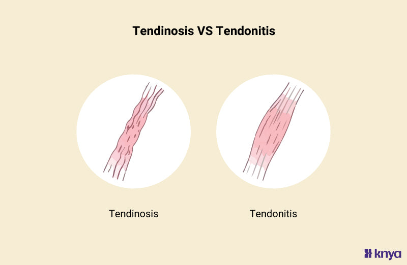 Tendinosis Vs. Tendonitis: Key Differences Explained! – Knya