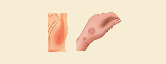 Contact Dermatitis vs Ringworm