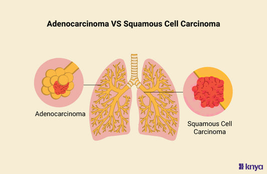 Adenocarcinoma vs Squamous Cell Carcinoma