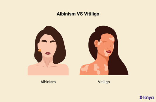 Albinism Vs Vitiligo