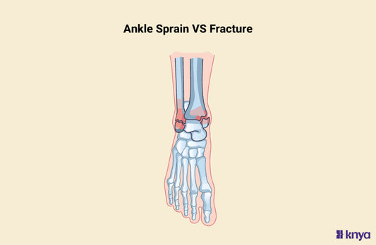 Ankle Sprain vs Fracture