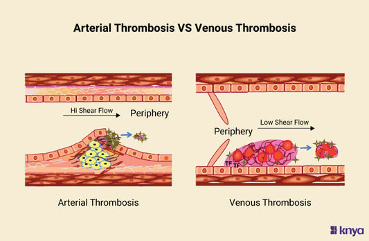 Arterial Thrombosis Vs Venous Thrombosis