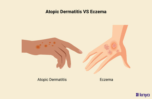 Atopic Dermatitis vs Eczema