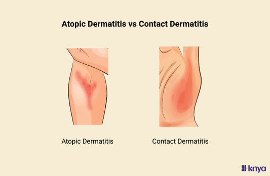 Atopic Dermatitis vs Contact Dermatitis