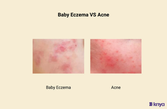 Baby Eczema vs Acne