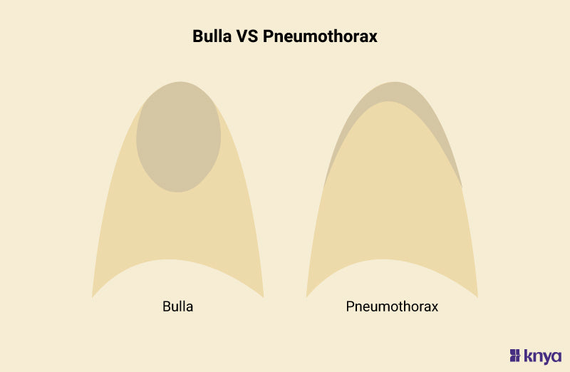 Bulla and Pneumothorax | Understand The Key Differences! – Knya