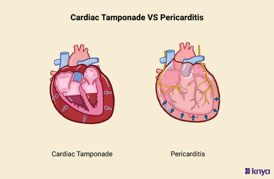 Cardiac Tamponade vs Pericarditis