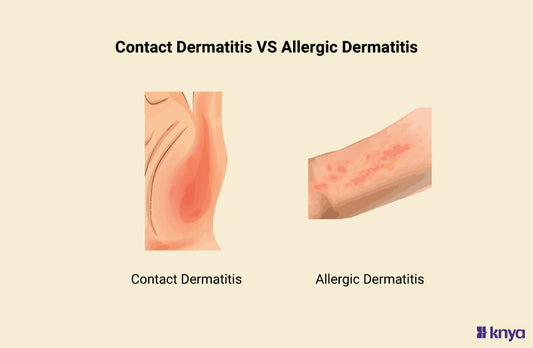 Contact Dermatitis vs Allergic Dermatitis