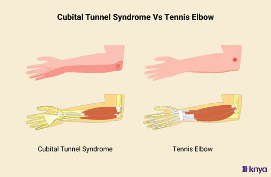 Cubital Tunnel Syndrome Vs Tennis Elbow