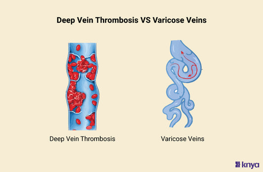 Deep Vein Thrombosis Vs Varicose Veins