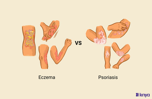 Difference Between Eczema And Psoriasis