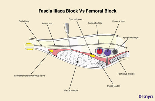 Fascia Iliaca Block Vs Femoral Block