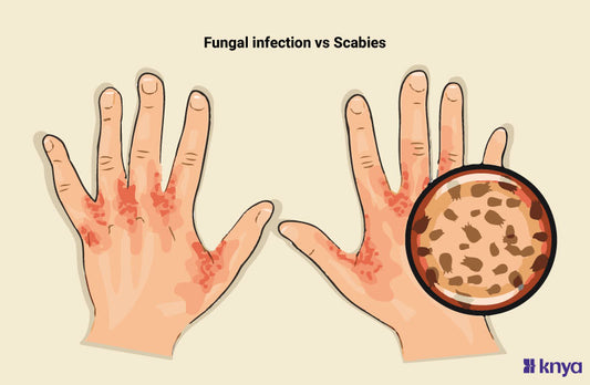 Difference between Fungal Infection and Scabies