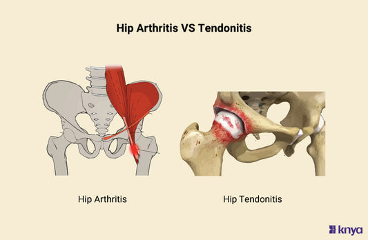 Hip Arthritis Vs Tendonitis
