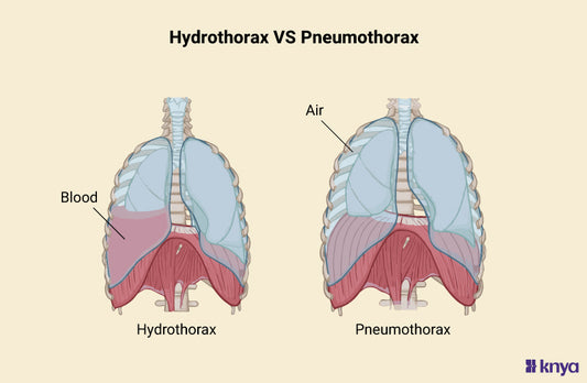 Difference Between Hydrothorax and Pneumothorax