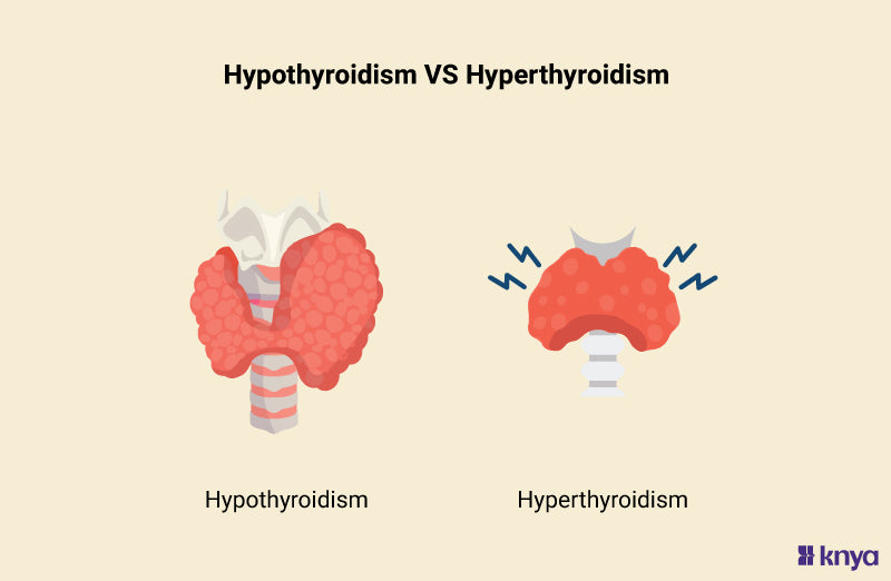 Hypothyroidism Vs Hyperthyroidism: Learn the differences – Knya