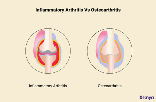 Inflammatory Arthritis Vs Osteoarthritis