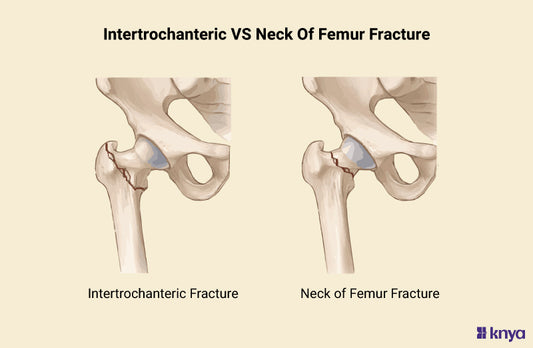 Difference Between Intertrochanteric and Neck Of Femur Fracture