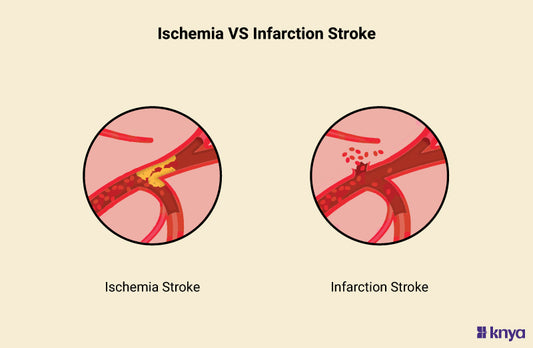 Ischemia Vs Infarction Stroke