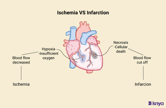 Ischemia Vs Infarction