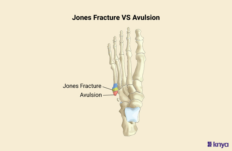 Difference Between Jones Fracture vs Avulsion – Knya