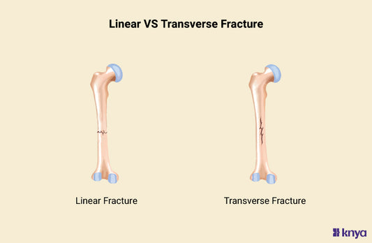 Linear vs Transverse Fracture