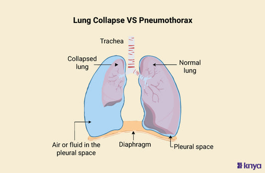 Lung Collapse Vs Pneumothorax