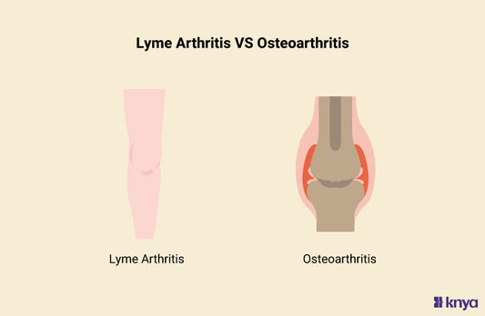Lyme Arthritis Vs Osteoarthritis