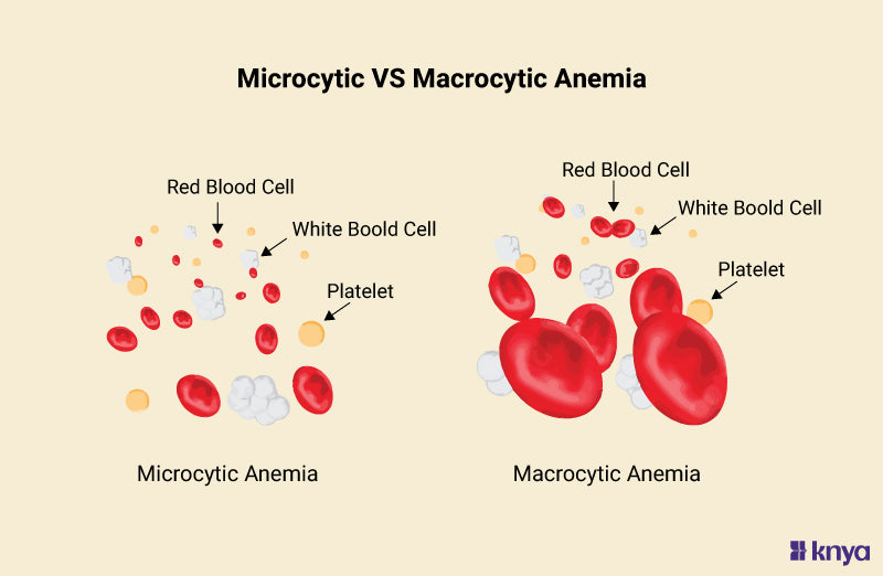 Difference Between Microcytic and Macrocytic Anemias | Explained! – Knya