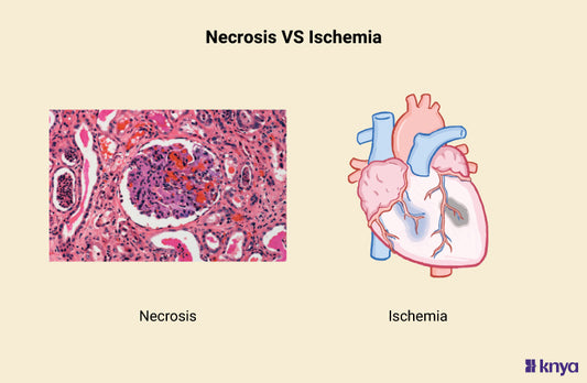 Difference Between Necrosis and Ischemia