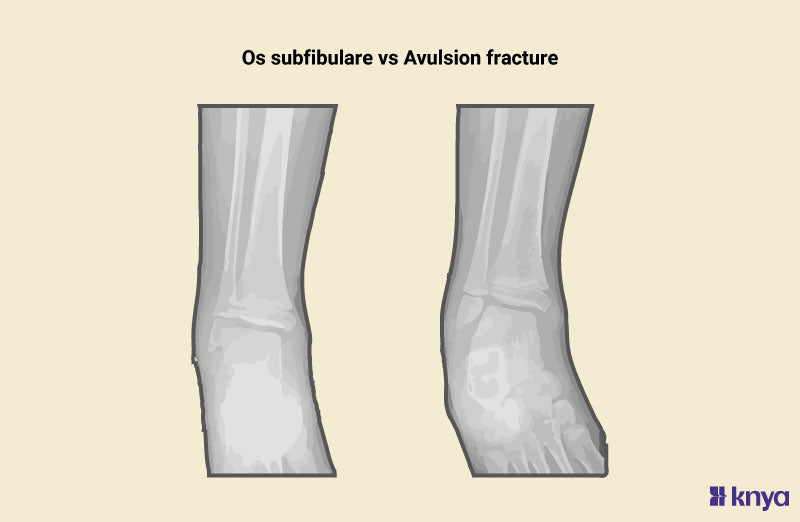 Os Subfibulare vs Avulsion Fracture: Know the Differences – Knya