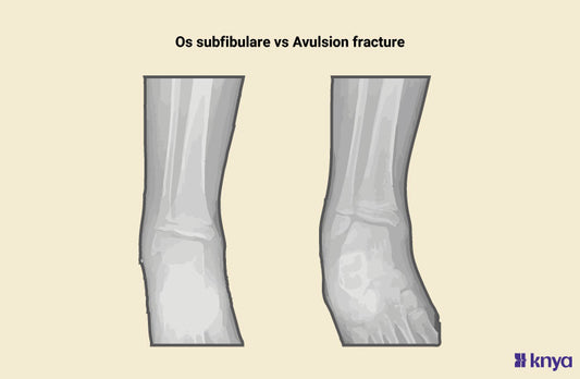 Os Subfibulare vs Avulsion Fracture