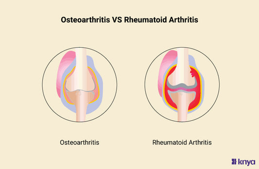 Difference Between Osteoarthritis and Rheumatoid Arthritis