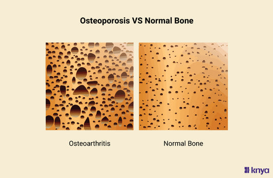 Osteoporosis Vs Normal Bone