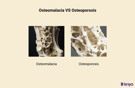 Osteomalacia vs Osteoporosis