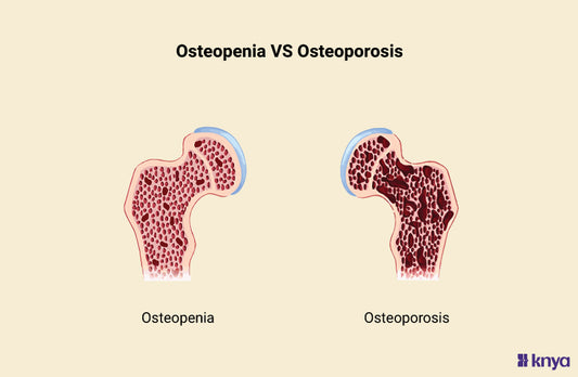 Osteopenia Vs Osteoporosis