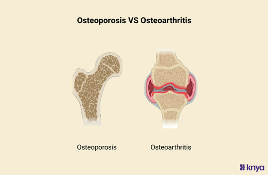 Difference Between Osteoporosis and Osteoarthritis