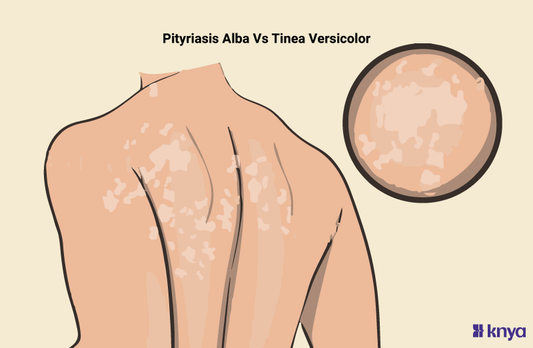 Pityriasis Alba Vs Tinea Versicolor