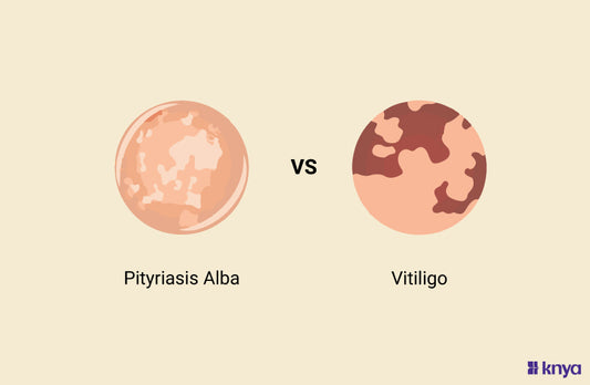 Pityriasis Alba Vs Vitiligo