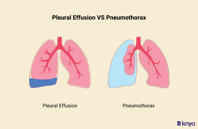 Pleural effusion vs Pneumothorax | Fluid Vs Air! – Knya