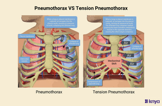 Pneumothorax Vs Tension Pneumothorax