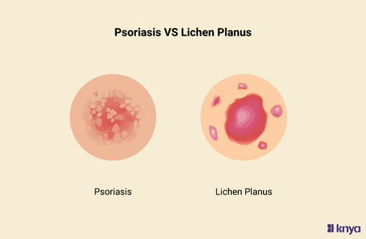 Difference Between Psoriasis and Lichen Planus