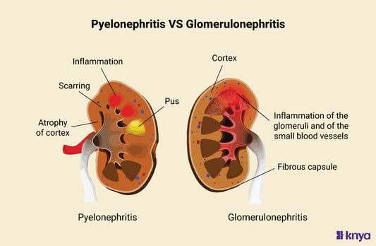Pyelonephritis Vs Glomerulonephritis