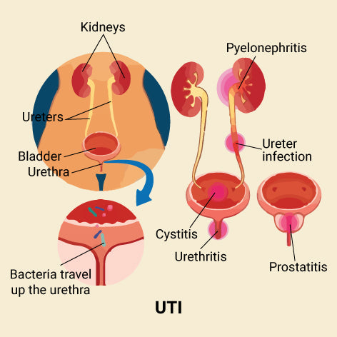 Pyelonephritis Vs UTI