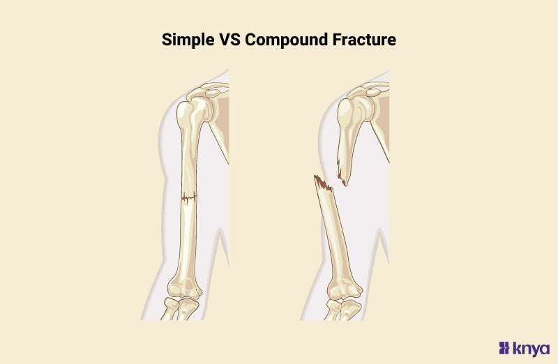 Simple Vs Compound Fracture: Know the difference – Knya