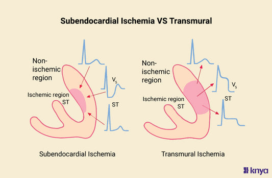 Subendocardial Ischemia Vs Transmural